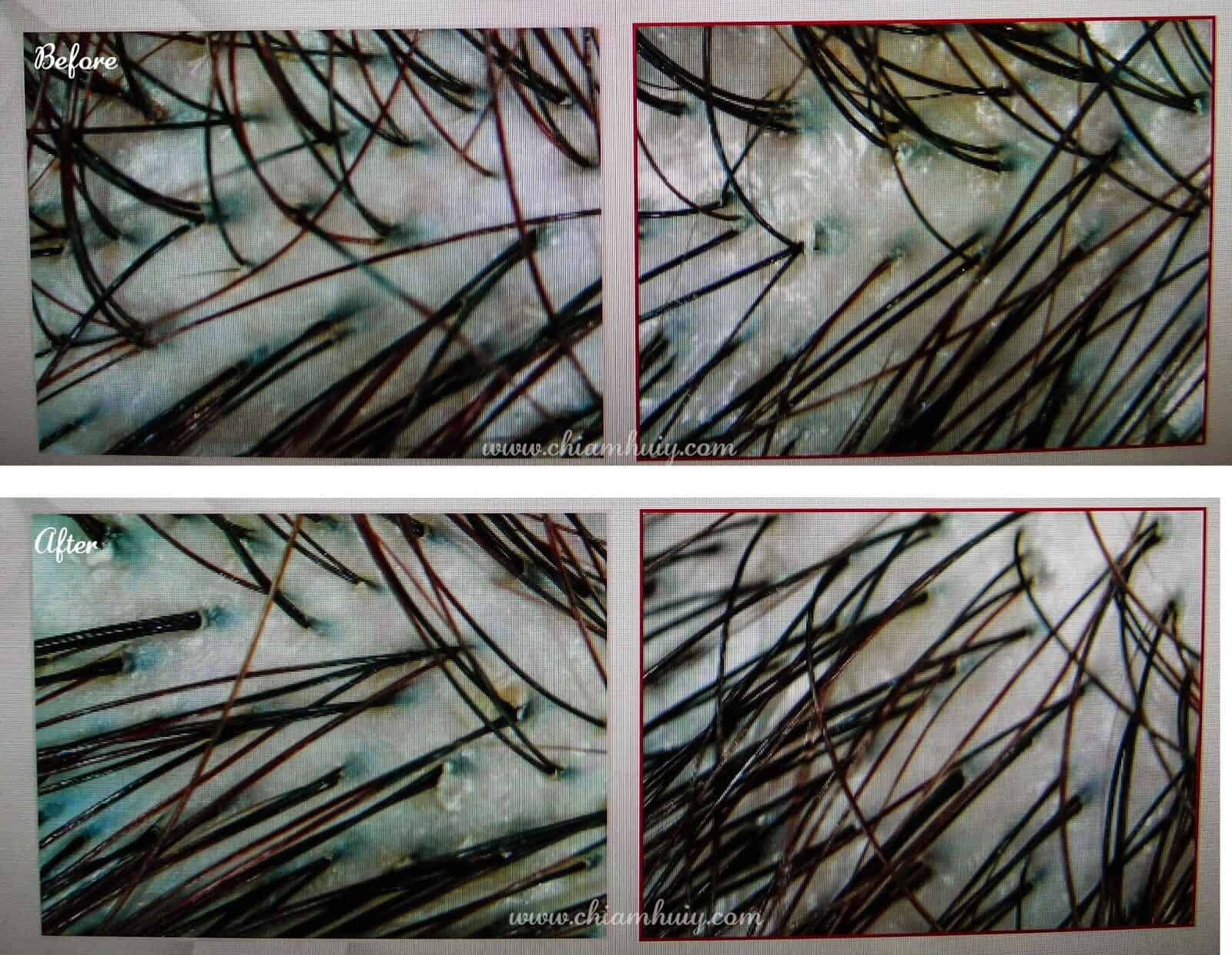 scalp2Btreatment2Bsingapore2Bbefore2Bn2Bafter 9473256 scalp2btreatment2bsingapore2bbefore2bn2bafter-9473256